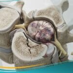 اصابة النخاع الشوكي