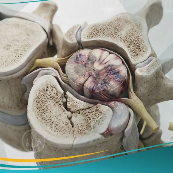 اصابة النخاع الشوكي