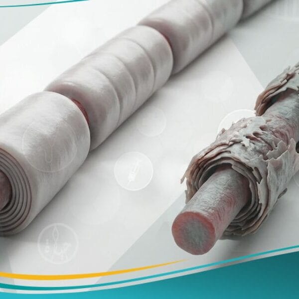 اعتلال عصبي