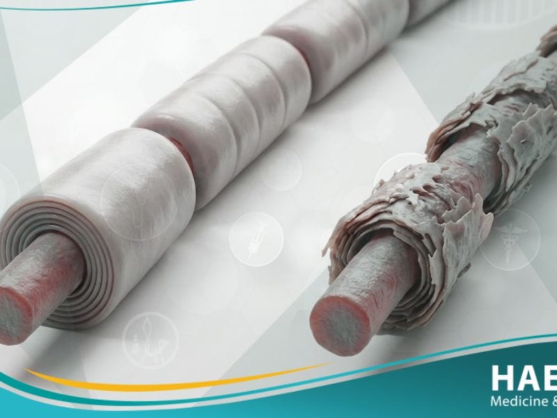 اعتلال عصبي