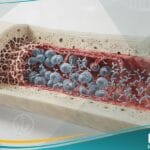 اعتلال غامائي وحيدة النسيلة