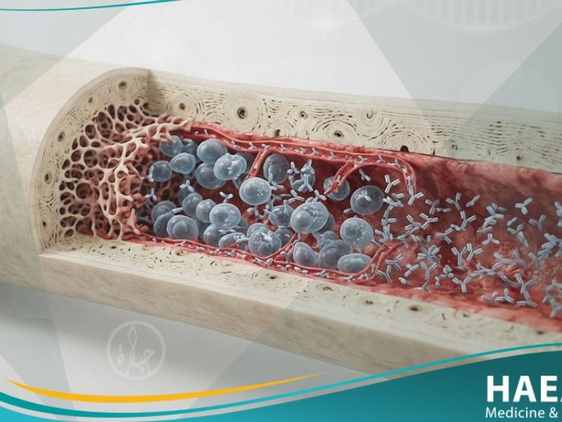 اعتلال غامائي وحيدة النسيلة