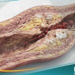 _اقفار الطرف الحرج