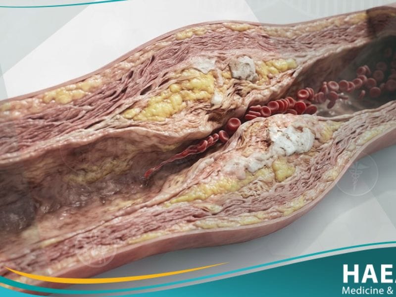 _اقفار الطرف الحرج