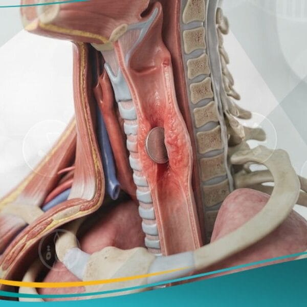 الأجسام الغريبة في المريء