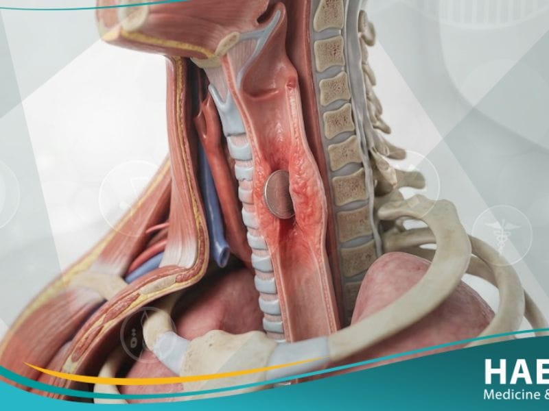 الأجسام الغريبة في المريء