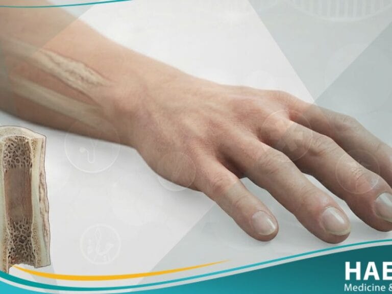 _الاعتلال المفصلي العظمي الضخامي