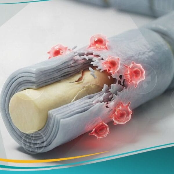 الاعتلالات العصبية الالتهابية