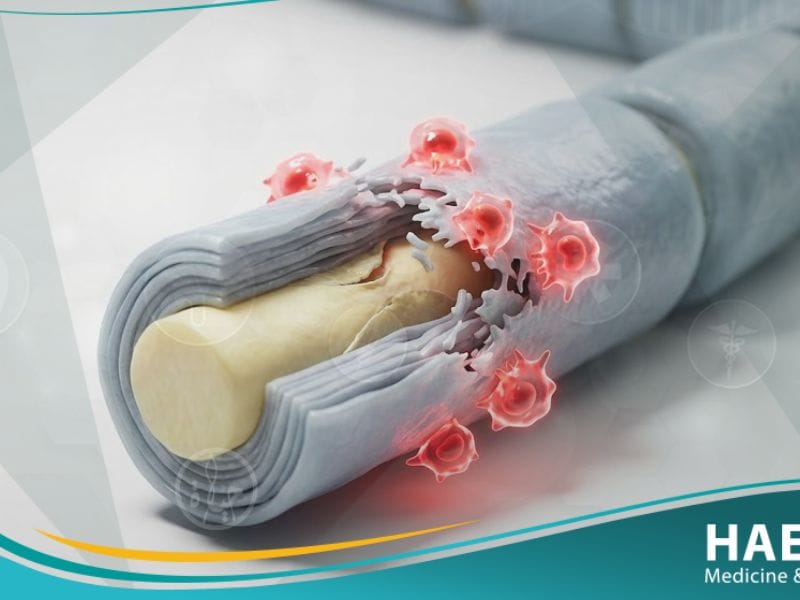 الاعتلالات العصبية الالتهابية