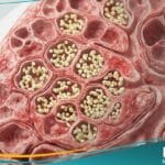 _الالتهاب الرئوي اليوزيني