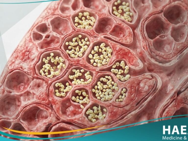 _الالتهاب الرئوي اليوزيني