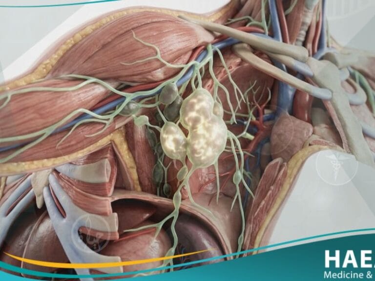 الاورام اللمفاوية (1)