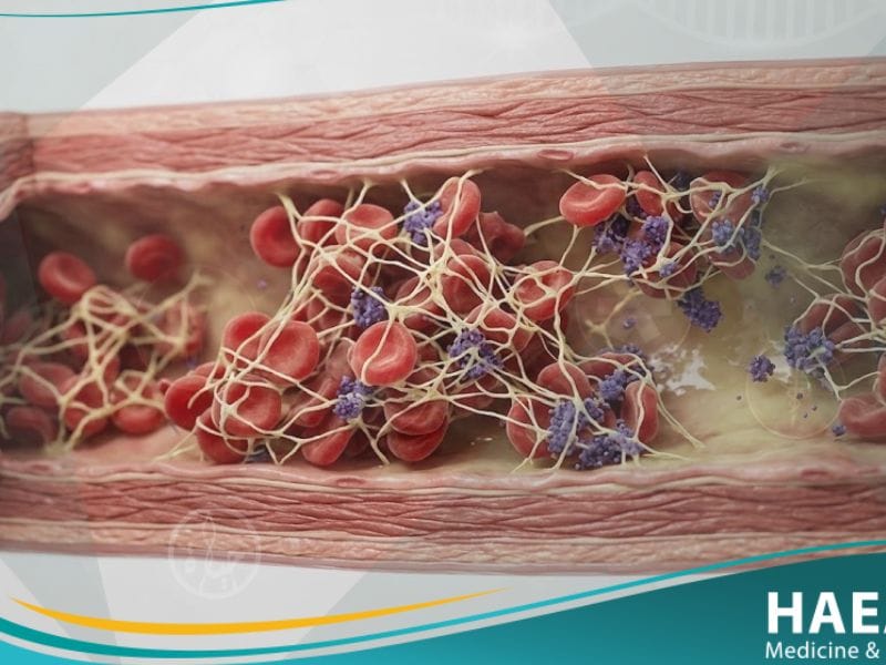التخثر المنتثر داخل الأوعية