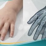 _التصاق الأصابع