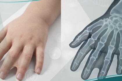 _التصاق الأصابع