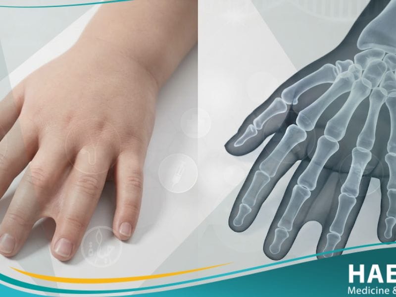 _التصاق الأصابع