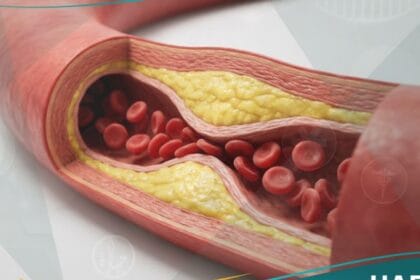 _التصلب العصيدي