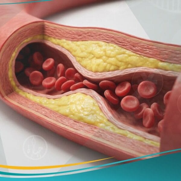 _التصلب العصيدي