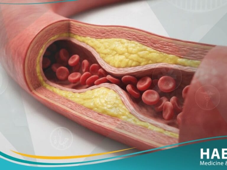 _التصلب العصيدي