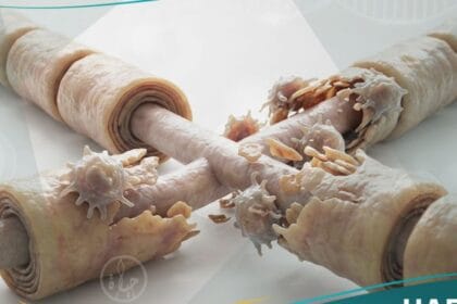 التصلب اللويحي