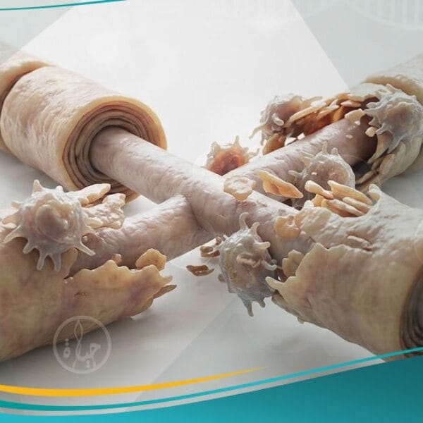 التصلب اللويحي