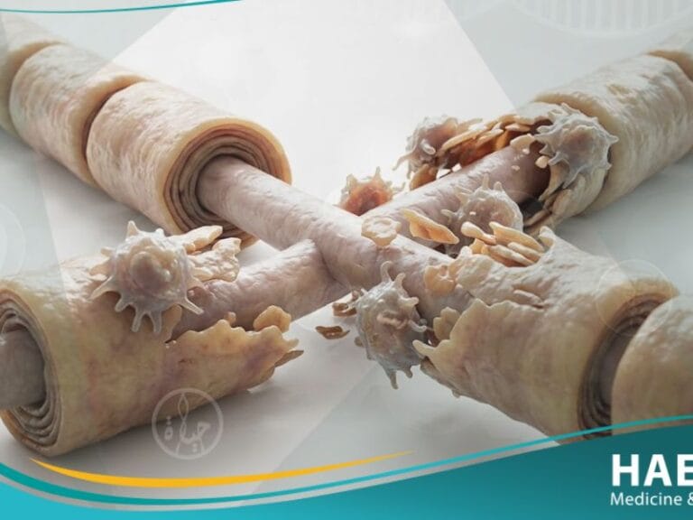 التصلب اللويحي