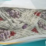 التليف النقوي المجهول السبب