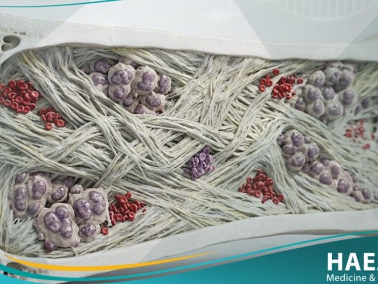 التليف النقوي المجهول السبب