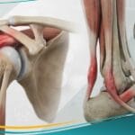 _التهاب الأوتار