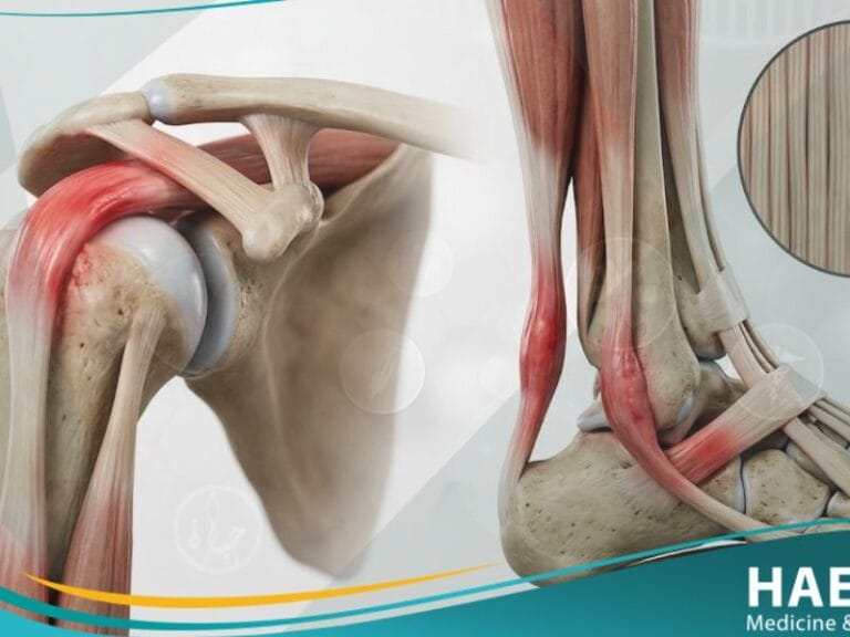 _التهاب الأوتار