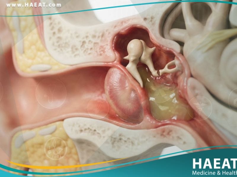 _التهاب الاذن