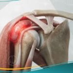 التهاب الجراب