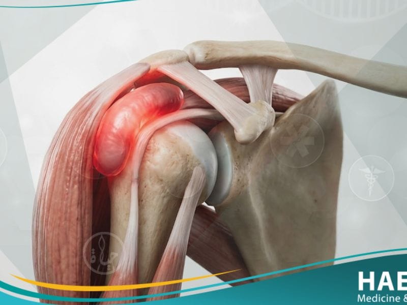 التهاب الجراب