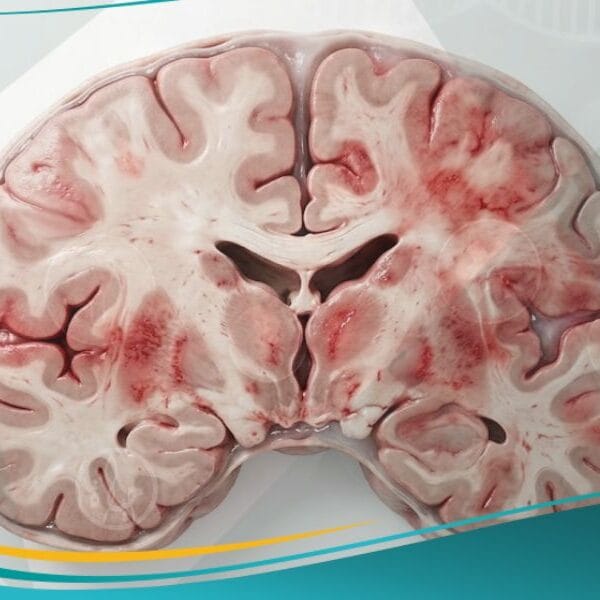 التهاب الدماغ