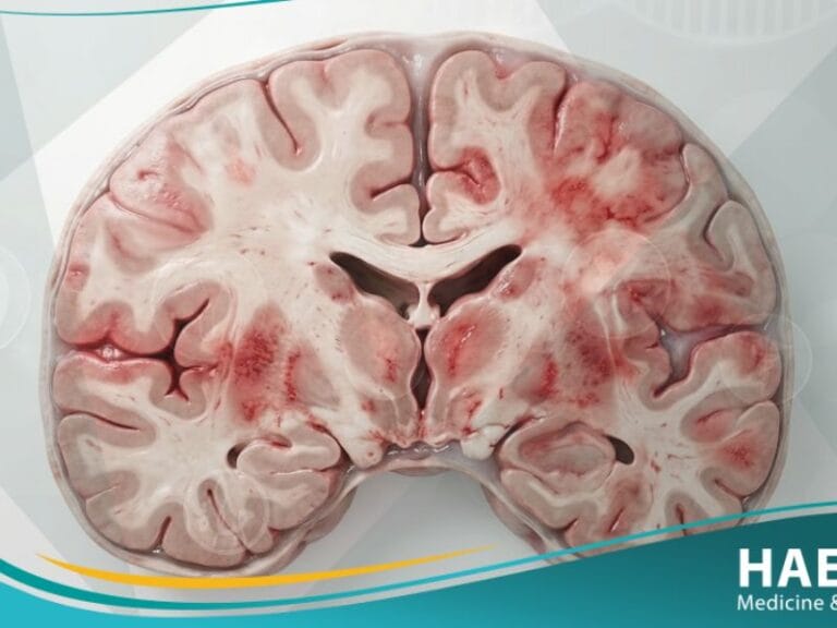 التهاب الدماغ