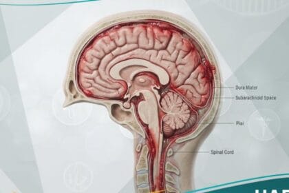 التهاب السحايا