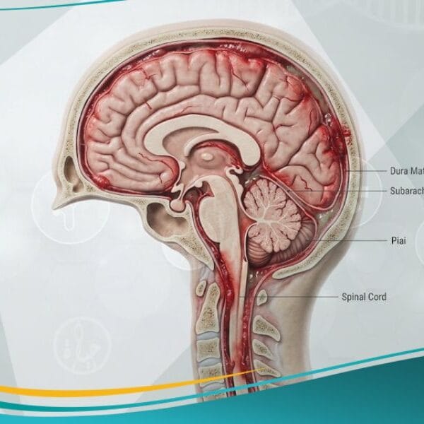 التهاب السحايا