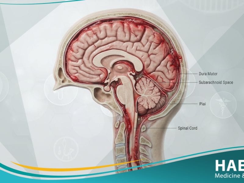 التهاب السحايا