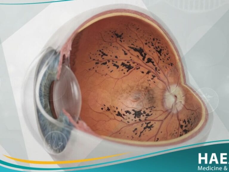 التهاب الشبكية الصباغي