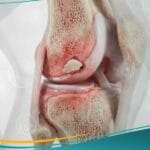 _التهاب العظم والغضروف