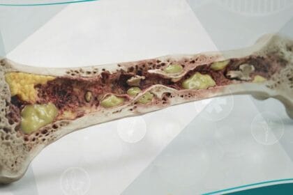 التهاب العظم والنقي