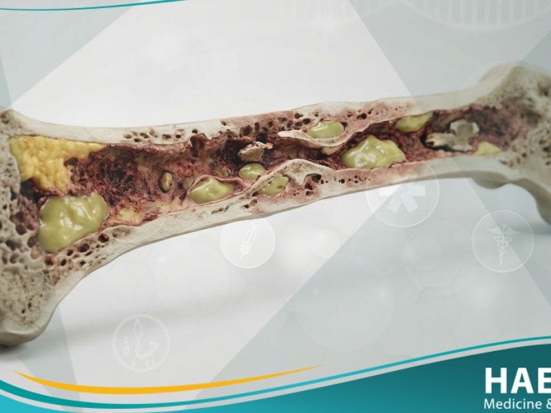 التهاب العظم والنقي