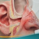 التهاب الغضروف (2)