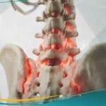 التهاب الفقار المقسط