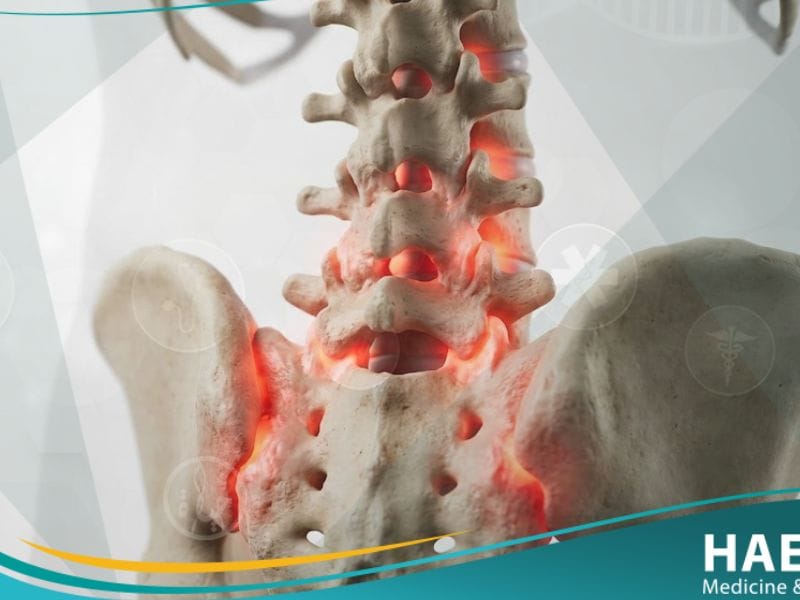 التهاب الفقار المقسط