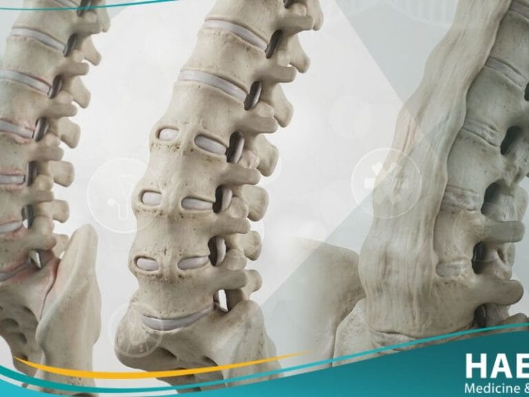 التهاب الفقرات التصلبي