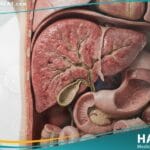 التهاب الكبد لدى حديثي الولادة