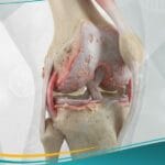 التهاب المفاصل