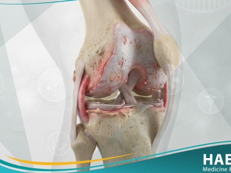 التهاب المفاصل