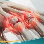 _التهاب المفاصل الروماتويدي